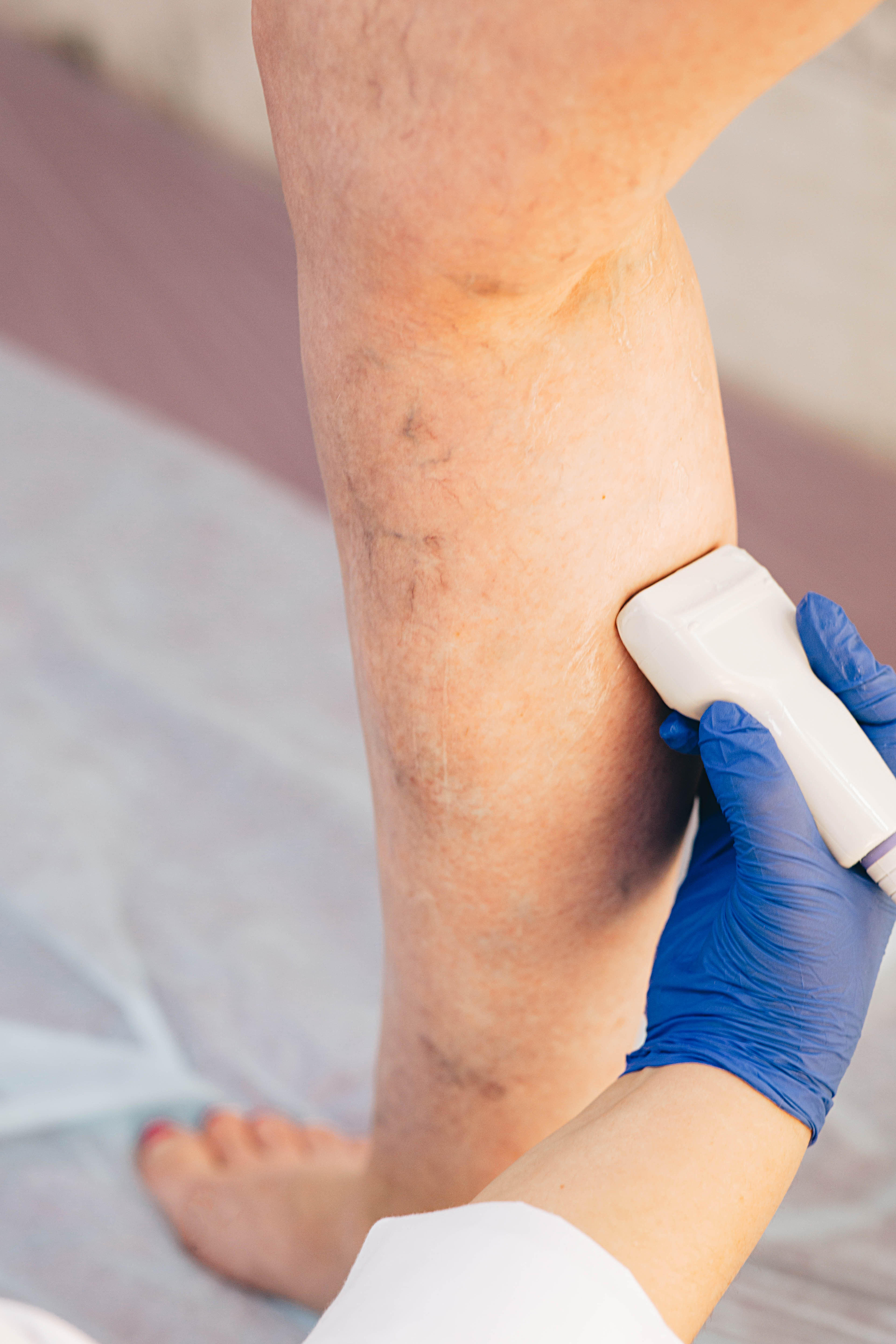 Tratamiento Láser para Varices