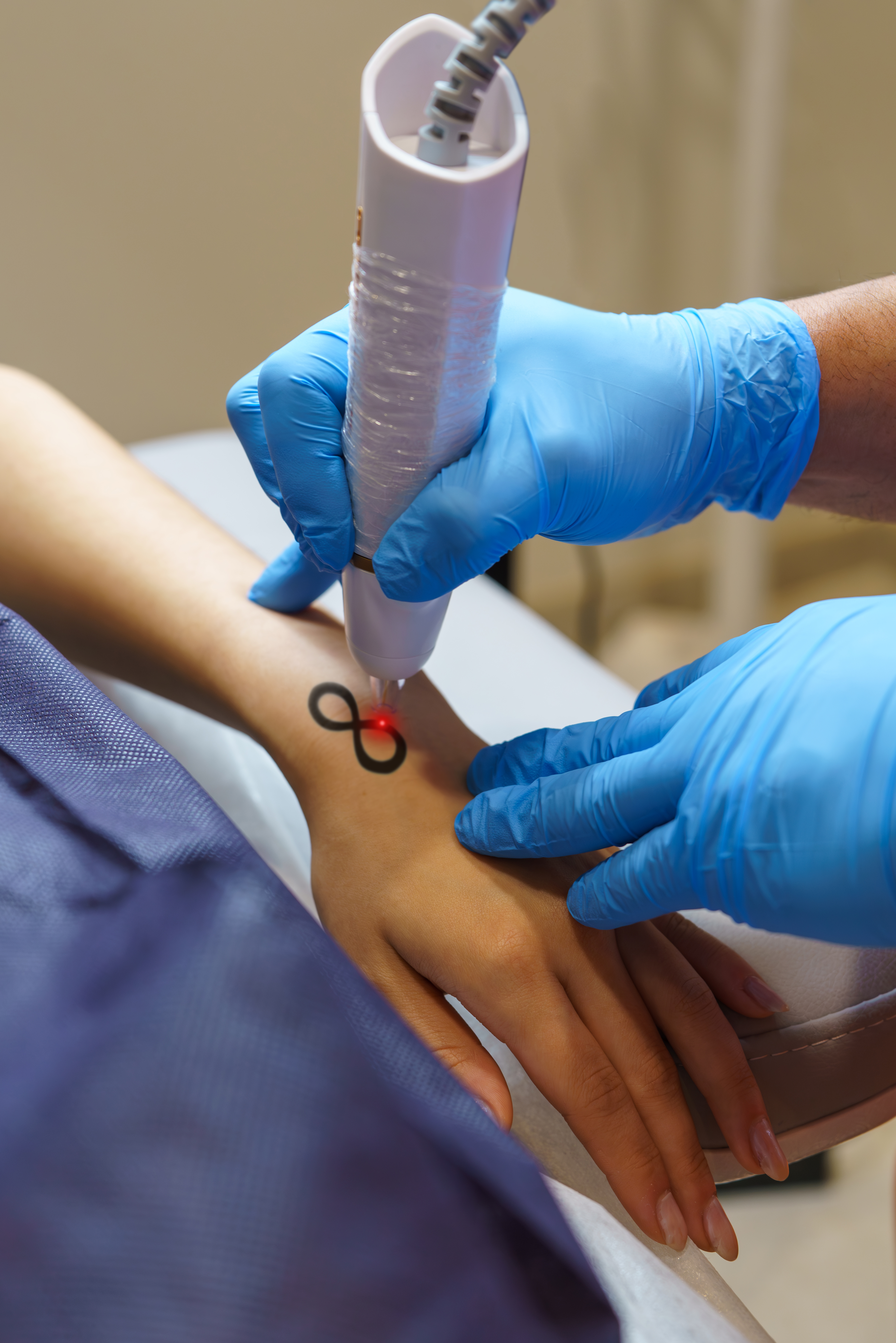 Eliminación de Tatuajes 